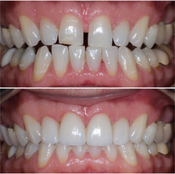 Porcelain Dental Veneers San Francisco