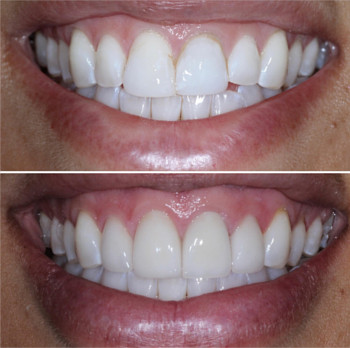 Teeth Veneers in San Francisco