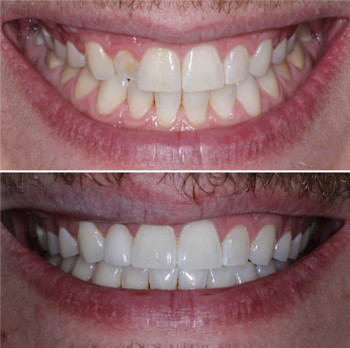 Dental Veneers in San Francisco, CA