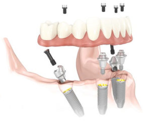 All-on-4 Denture San Francisco