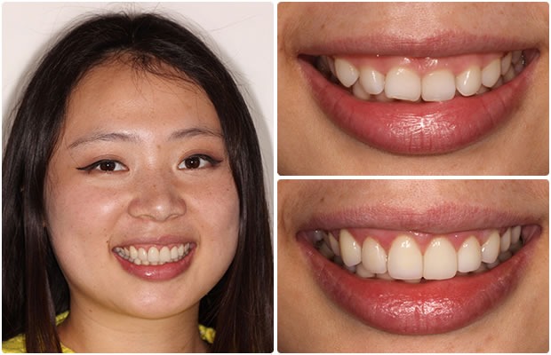 Dental Veneers San Francisco