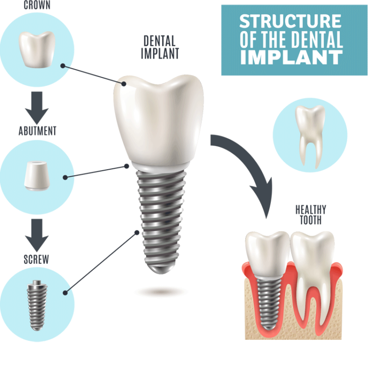 Dental Implants in San Francisco