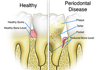Periodontal Gum Disease Treatment in San Francisco