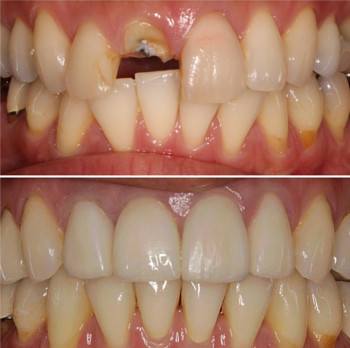 Dental Implants San Francisco Before and After 1