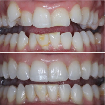 Invisalign Treatment in San Francisco